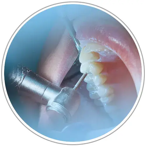 Endodoncias